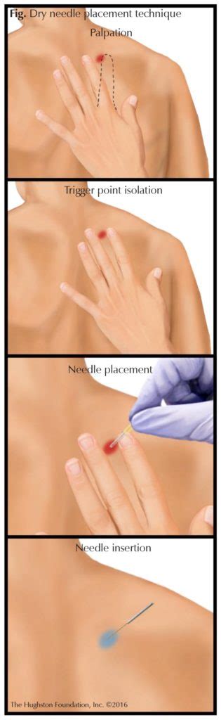 Dry Needling: What You Should Know - Hughston Clinic