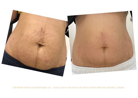 Laser Stretch Mark removal | Stretch Mark Treatment | Las Vegas Stretch ...