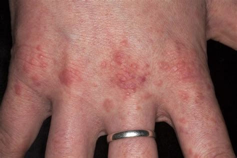 Skin Manifestations of Chronic Hepatitis C Virus Infection ...