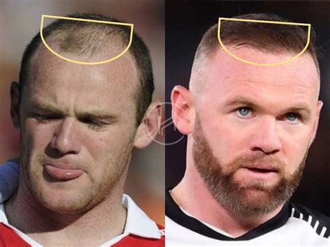 The six most fantastic hair transplants in football history from Wayne ...