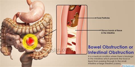 Pin on Probiotics