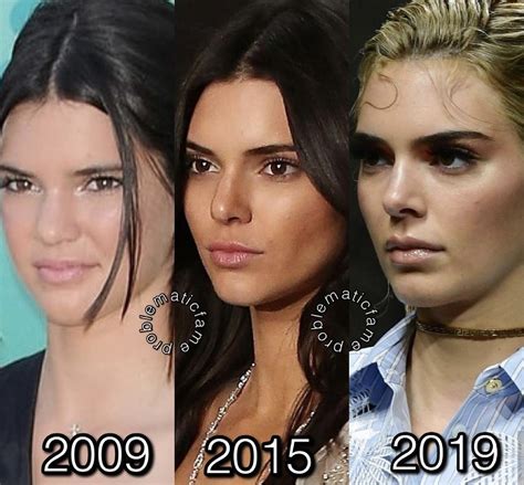 Kendall Jenner Surgery, Get Taller Exercises, Nose Job, Kardashian ...