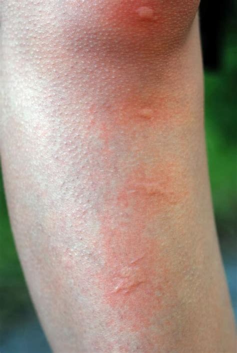 Mosquito Bites Pictures Allergic Reaction