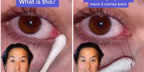 Experts warn against 'fishing' out eye mucus trend as seen on TikTok ...