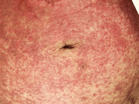 Case 1: Photograph of the peri-umbilical petechial abdominal rash ...