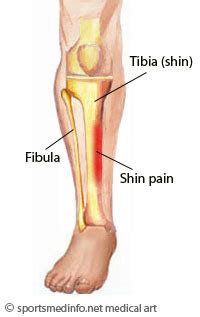 Shin Splints ;tibialis posterior tendonitis, periostitis (inflammation ...