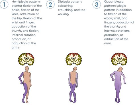 Cerebral Palsy – HCP – Lioresal® Intrathecal