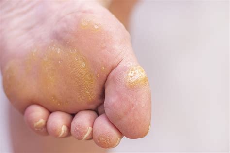 Tips for Foot Wart Removal at Home - Foot and Ankle Group