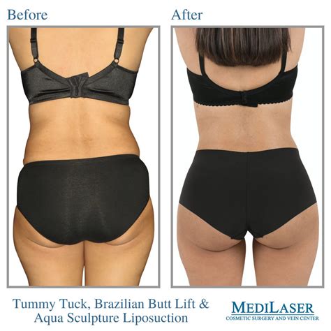 Tummy Tuck, BBL, and Liposuction Before and After, Frisco Texas ...