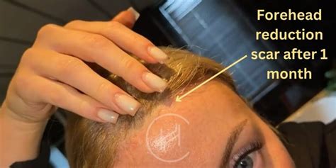 Forehead Reduction (Hairline Lowering) in Turkey - Costs in 2025 - Heva ...