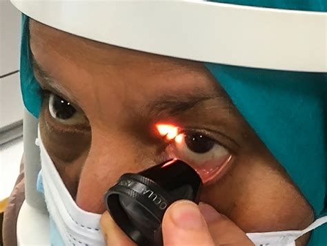 Community Eye Health Journal » Gonioscopy skills and techniques