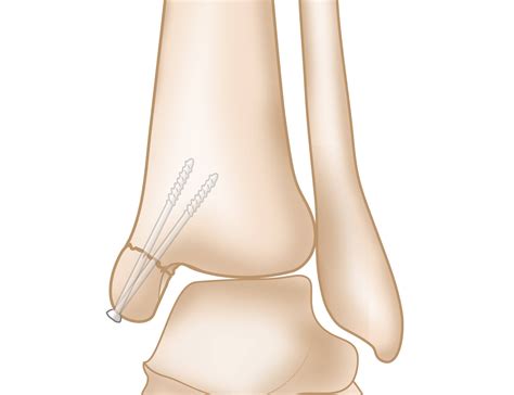 Medial Malleolus Anatomy