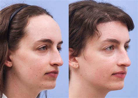 Forehead Reduction Before and After 03