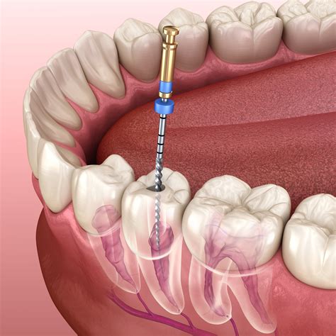 What You Need To Know Before Your Root Canal Procedure