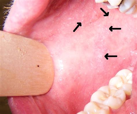 Rubeola (Measles) - Microbiology - Medbullets Step 1