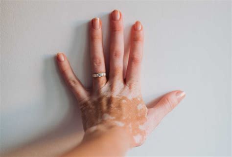 Understanding Vitiligo - Causes Vs Triggers | Dr. Will Cole