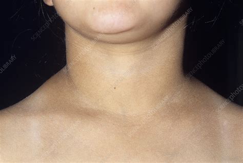 Thyroid Lips Swelling | Sitelip.org