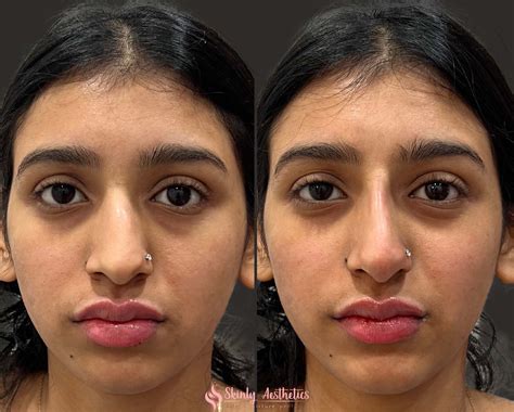 Non-Surgical Rhinoplasty - Before and After Results