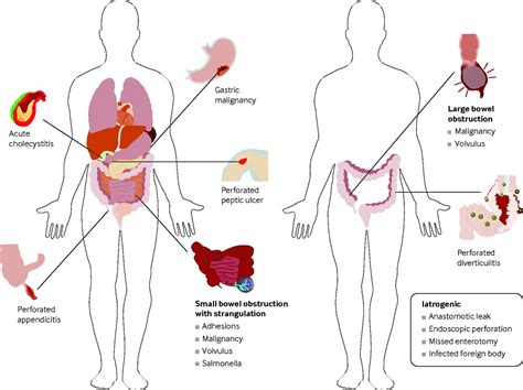 Secondary peritonitis: principles of diagnosis and intervention | The BMJ