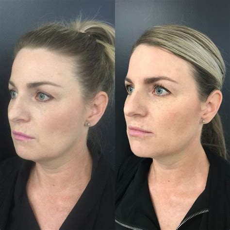 Dermal Cheek Fillers | Cheek Injections & Facial Threads for Cheek Lift