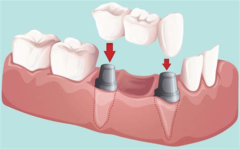 Dental Bridge Abutment