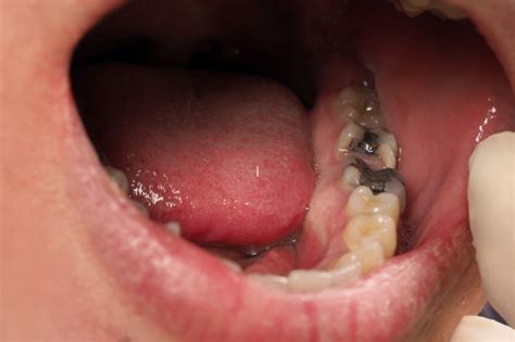 Cavities (Tooth Decay): Symptoms, Causes & Treatment - weheartanimals.info