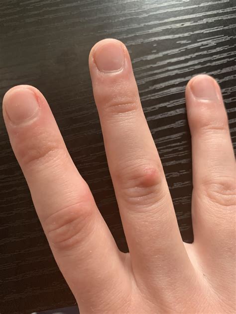 Red swollen bumps on finger joints : r/DiagnoseMe