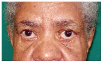 RBCP - Eyelid polyposis caused by eccrine hidrocystoma