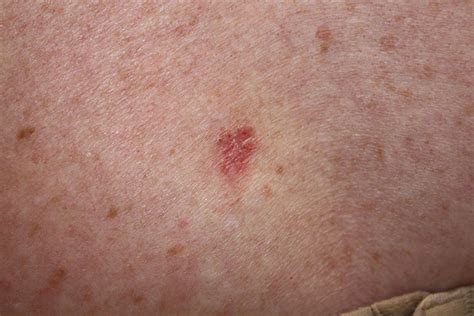 Basal Cell Carcinoma: Appearance and Treatment | Dermatology Consultants