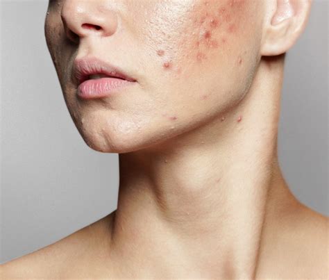 Dealing with Autumn Acne: Tips for a Clearer Complexion