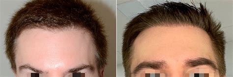 Eyebrow Hair Transplant photos | Miami, FL | Patient121673