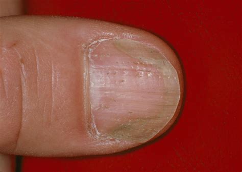 Psoriasis Of The Toenail