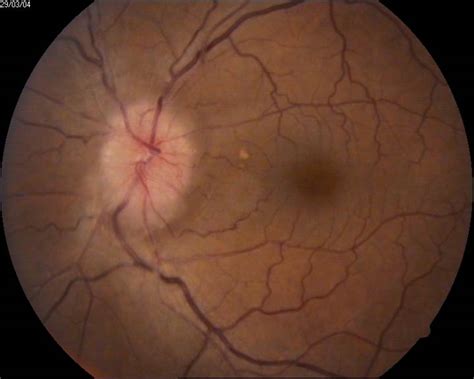 Optic Nerve Disease - Eye Specialist, Treatments, Types and Symptoms