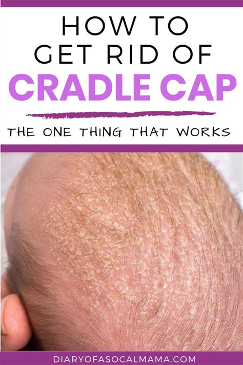 Cradle Cap: the Best way to get rid of it! | Cradle cap, Cradle cap ...