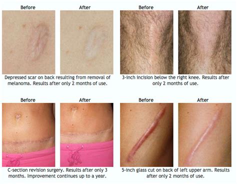 Burning Vulva Treatment: Old Keloid Scar Treatment