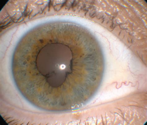 Lesson: What to Do When You See Uveitis