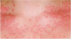 hepatitis rash - pictures, photos