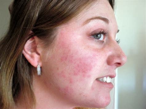 What Causes A Red Itchy Rash On Face - Printable Templates Protal