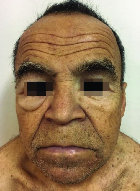 Myxedema, periorbital edema, and pallor of the skin in a patient with ...