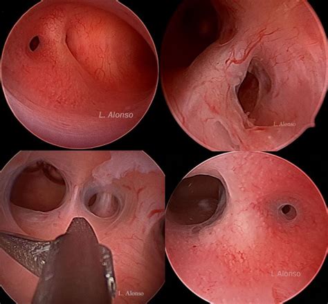 Etiopathogenesis of Asherman’s Syndrome – Hysteroscopy Newsletter