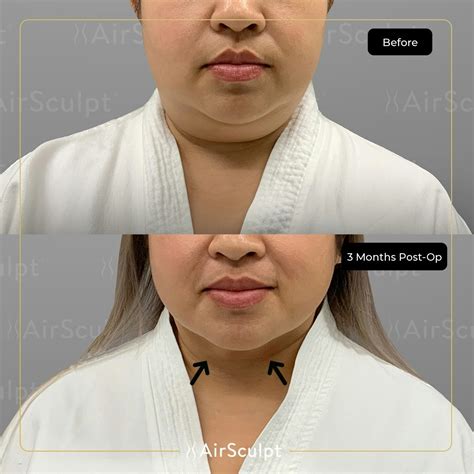 How Chin AirSculpt® + Overhauled This Chicago Patient's Profile