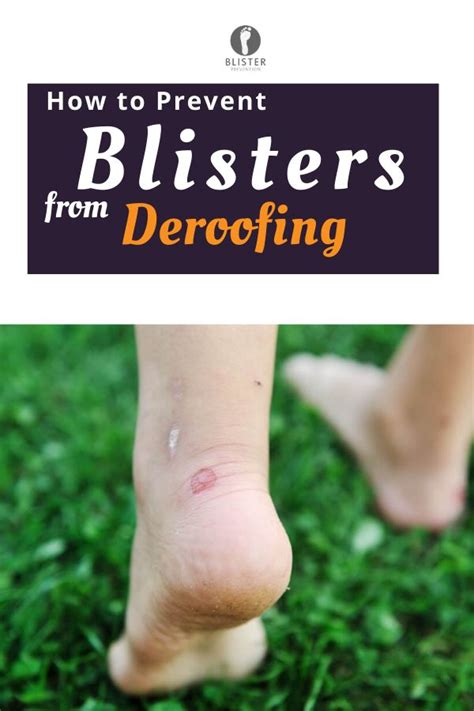 Deroofed Blisters: Here's What You Need To Know | Blister treatment ...