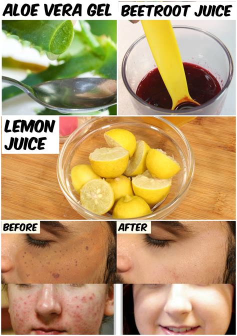 Does Lemon Juice Get Rid Of Acne Scars - HOWOTREMVO