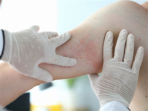 When is a drug rash more than just a rash? - Harvard Health