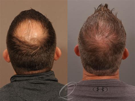 Male FUE Hair Transplant Before and After Pictures Case 1001537 ...