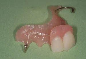 Dental flipper choices - What are your options? What's cost?