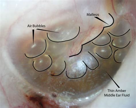 Fluid In Ear Draining