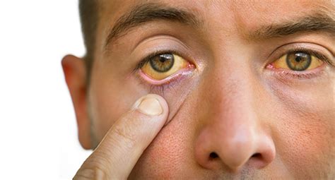 Why Do I Have Yellow Eyes? - Centre For Sight