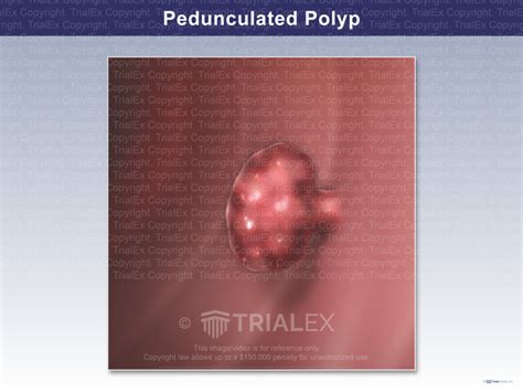 Pedunculated Polyp - Trial Exhibits Inc.