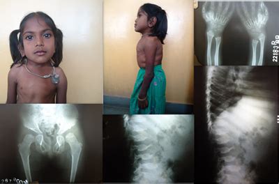 Short Stature | Spot Diagnosis | Pediatric Oncall